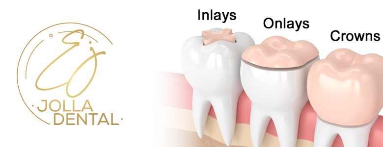 Inlays & Onlays‏‏