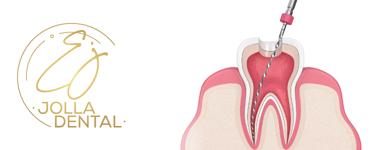 Root Canals ㅤ ‎‏‏‎ ‎‏‏‎ ‎‏‏‏‏