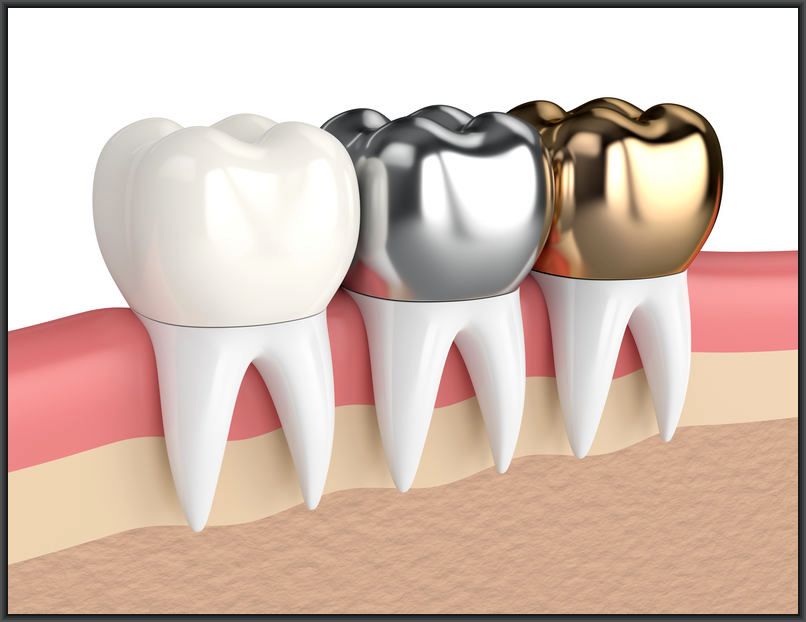 Capsula Dente Devitalizzato: Tutto Quello che Devi Sapere (Durata e Vantaggi)