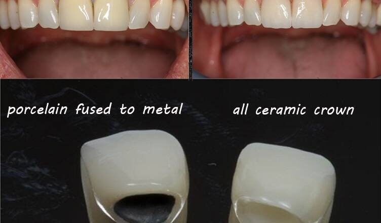 zirconio o ceramica