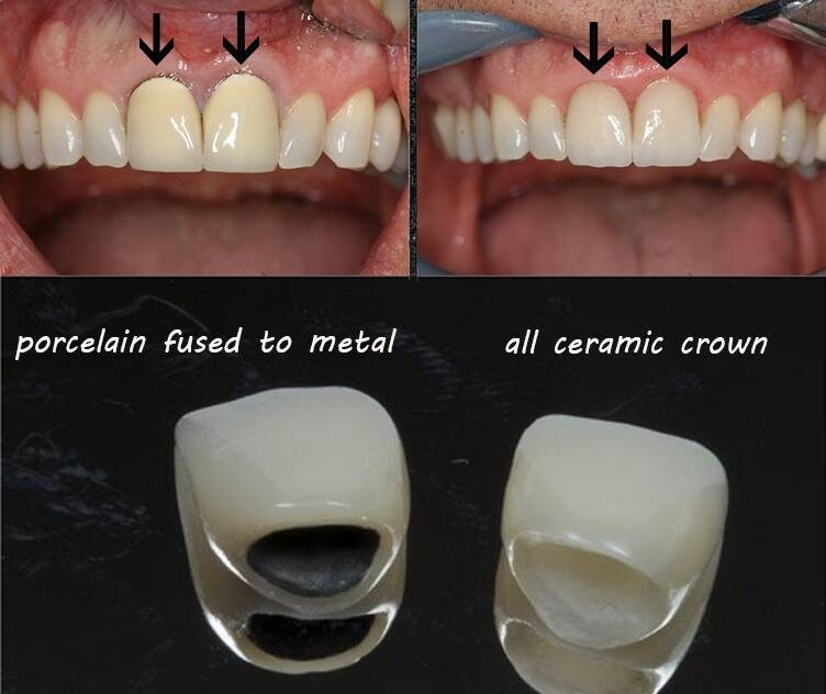 Zirconio o Ceramica: Quale Materiale Scegliere per le Tue Corone e Ponti Dentali